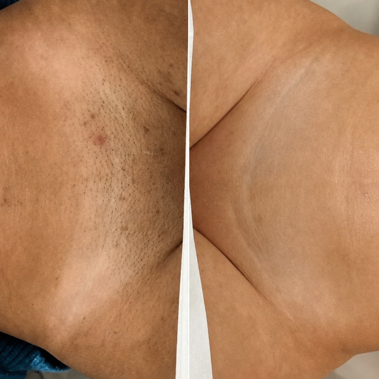 SKINRAZR™ — Rasuradora de precisión para una piel suave